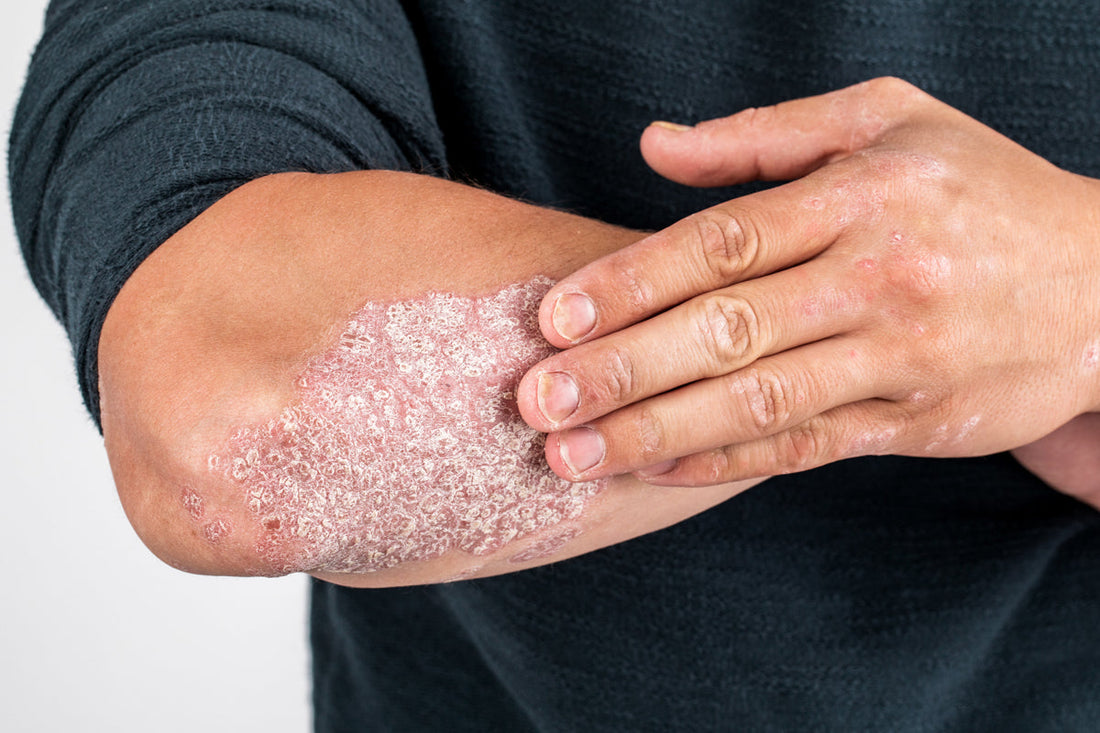 Cómo Mejorar los Síntomas de la Psoriasis y Preguntas Frecuentes